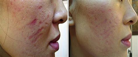 face rolling before and after|Dermarolling Before and After Pics .